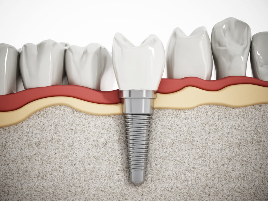 Dental Implants Explained